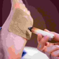 Moxibustion Moxibustion